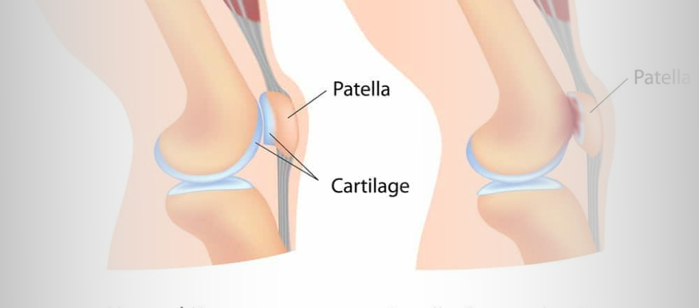 Managing Patellofemoral Pain Syndrome: New Research Insights and Treatment  Strategies — ChiroUp